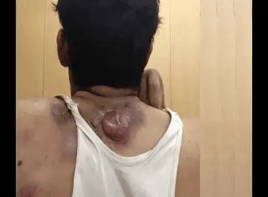 "With 4 months of Immunotherapy Sarcoma has completely healed"